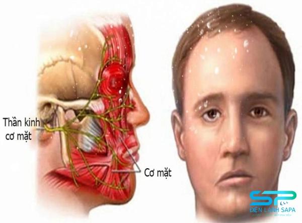 dấu hiệu liệt dây thần kinh 7 ngoại biên
